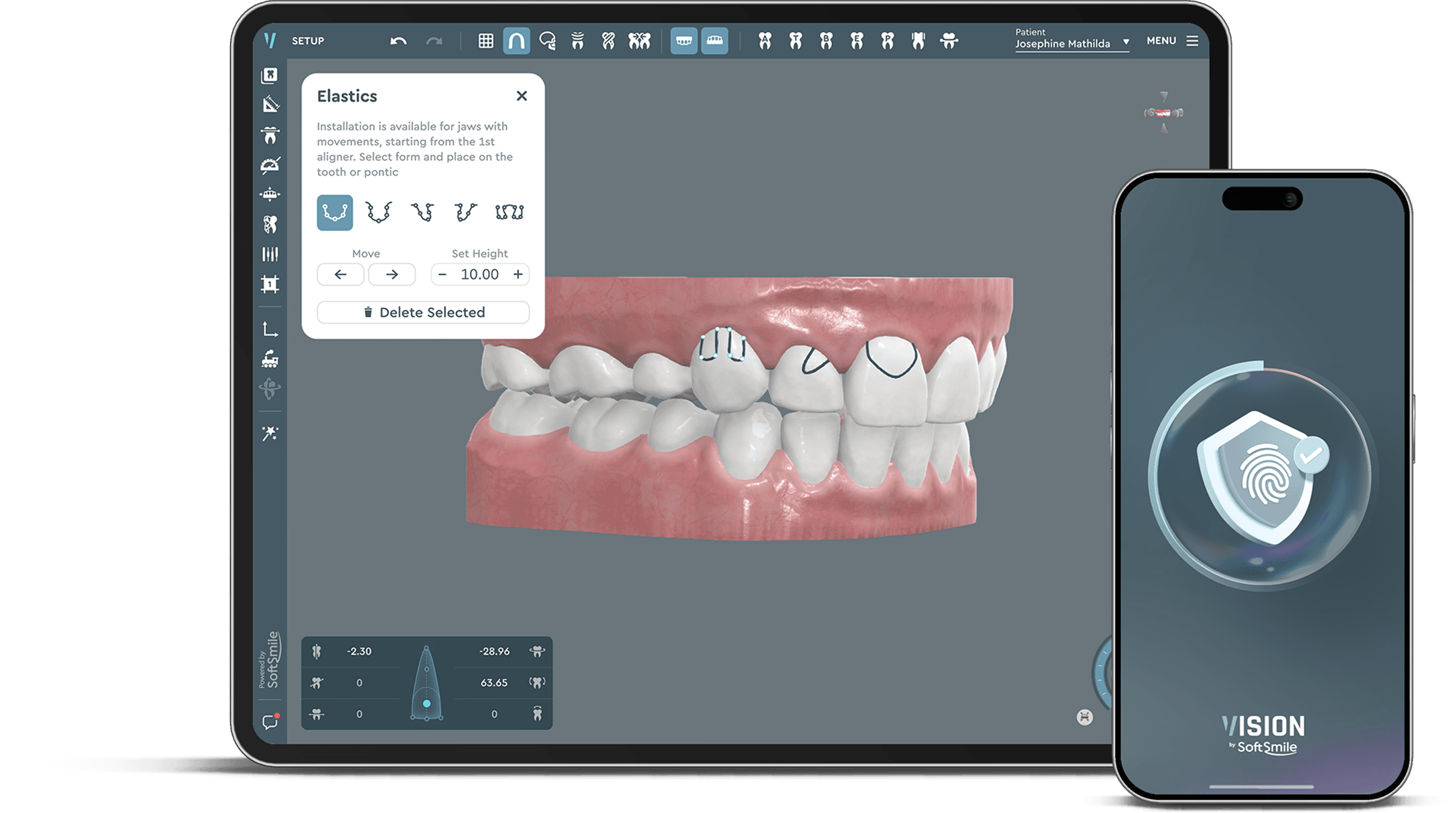 Aligner treatment planning software