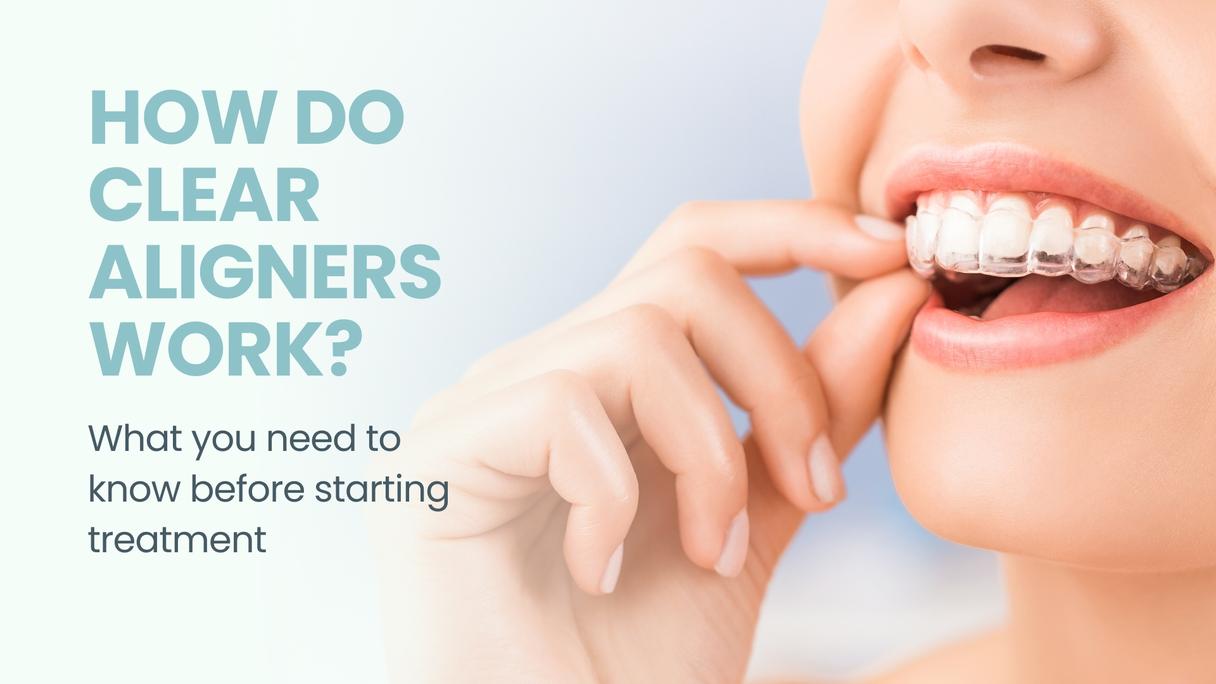 What are clear aligners and how do they work